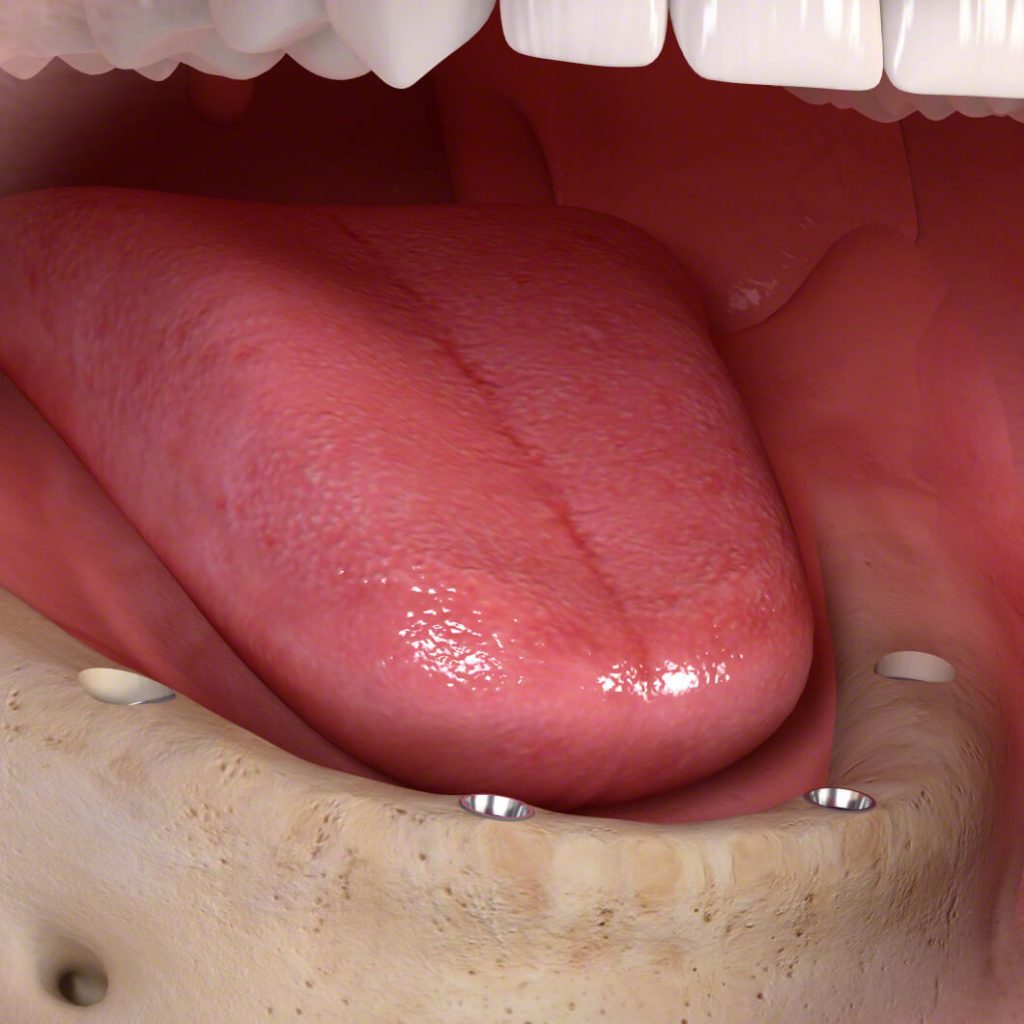 fog implantátum beültetése