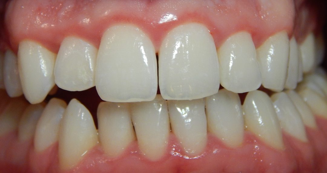 A fogínygyulladás oka, kialakulása, tünetei és kezelése