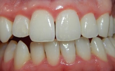 A fogínygyulladás oka, kialakulása, tünetei és kezelése