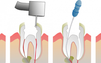 Mikor jó megoldás a gyökérkezelés?