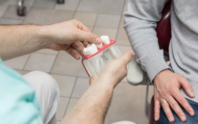 Fogimplantátum árak – hogyan kalkuláljunk?