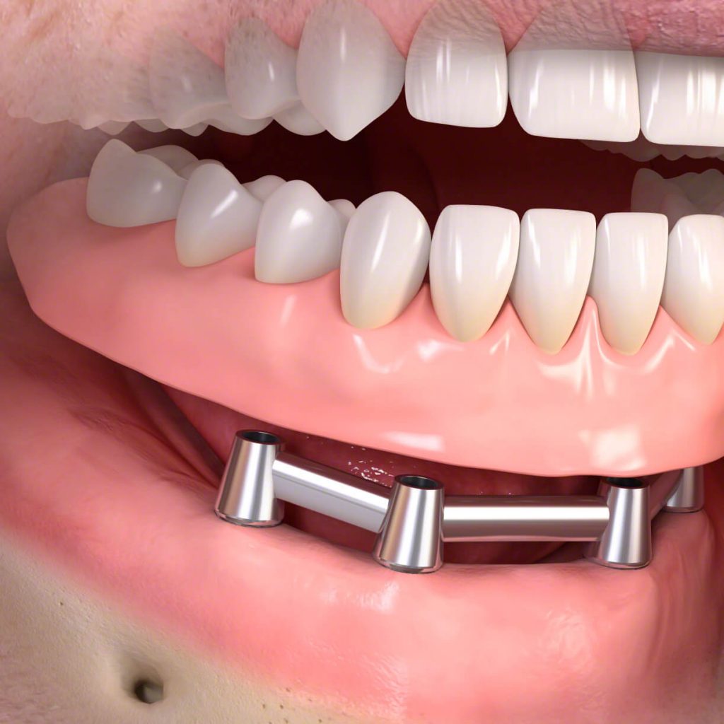 A fix fogsor lelke a rögíztésért felelős mini implantátum