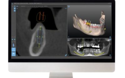 Navigált sebészet az implantológiában