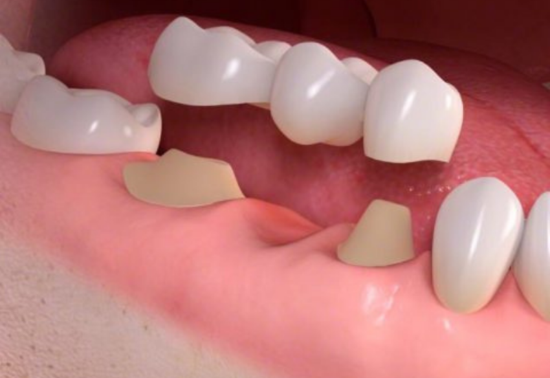 A hagyományos fogászati híd lecsiszolt fogakra rögzül