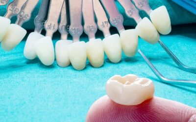 Fogkorona: a megoldás egyetlen fog pótlására