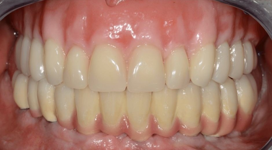 Protézis illesztéskor