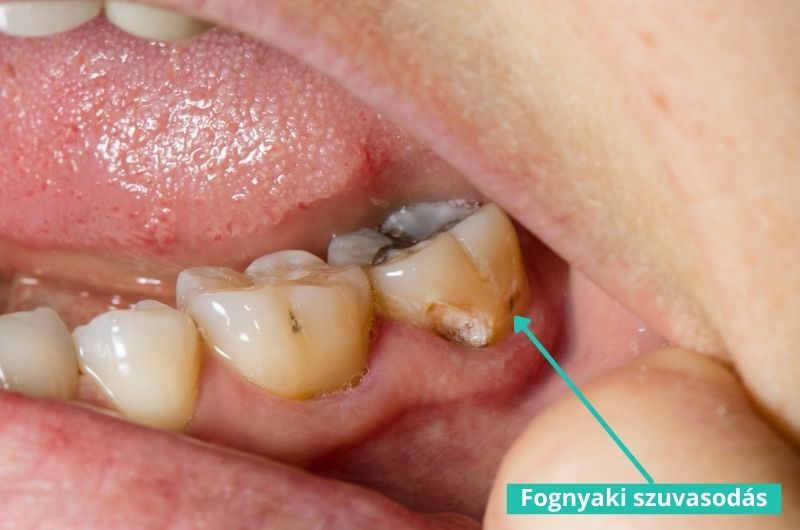 A fognyaki szuvasodás kezelése történhet fognyaki töméssel