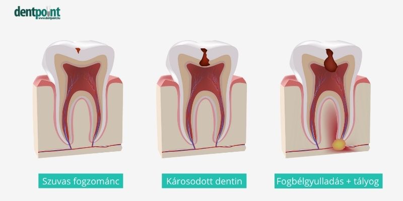 A gyulladt fog leggyakoribb oka a kezeletlen fogszuvasodás