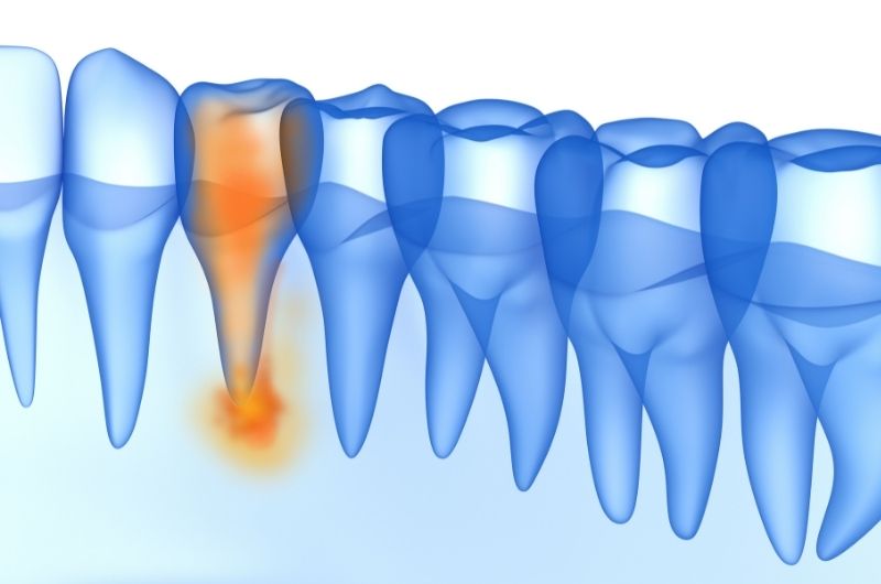 a foggyökér gyulladása már csak gyökérkezeléssel orvosolható