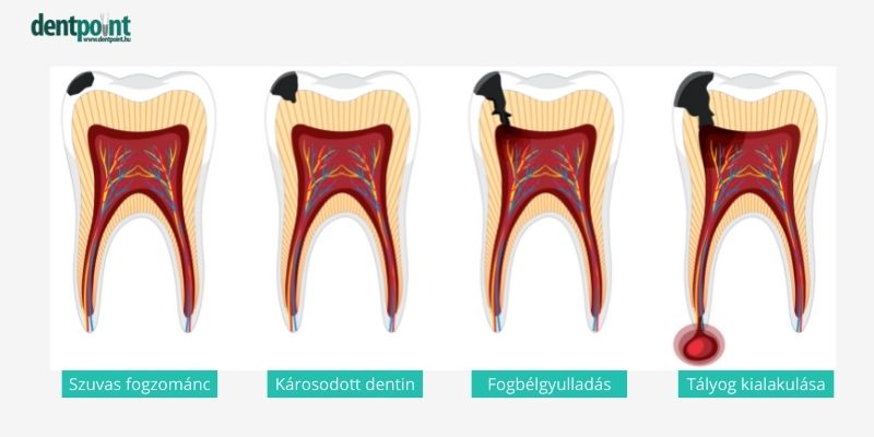 A lyukas fog, azaz fogszuvasodás stádiumai