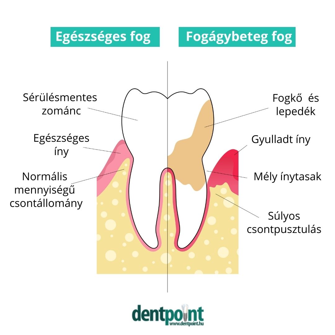 A parodontológus feladata a fogágybetegség kezelése is