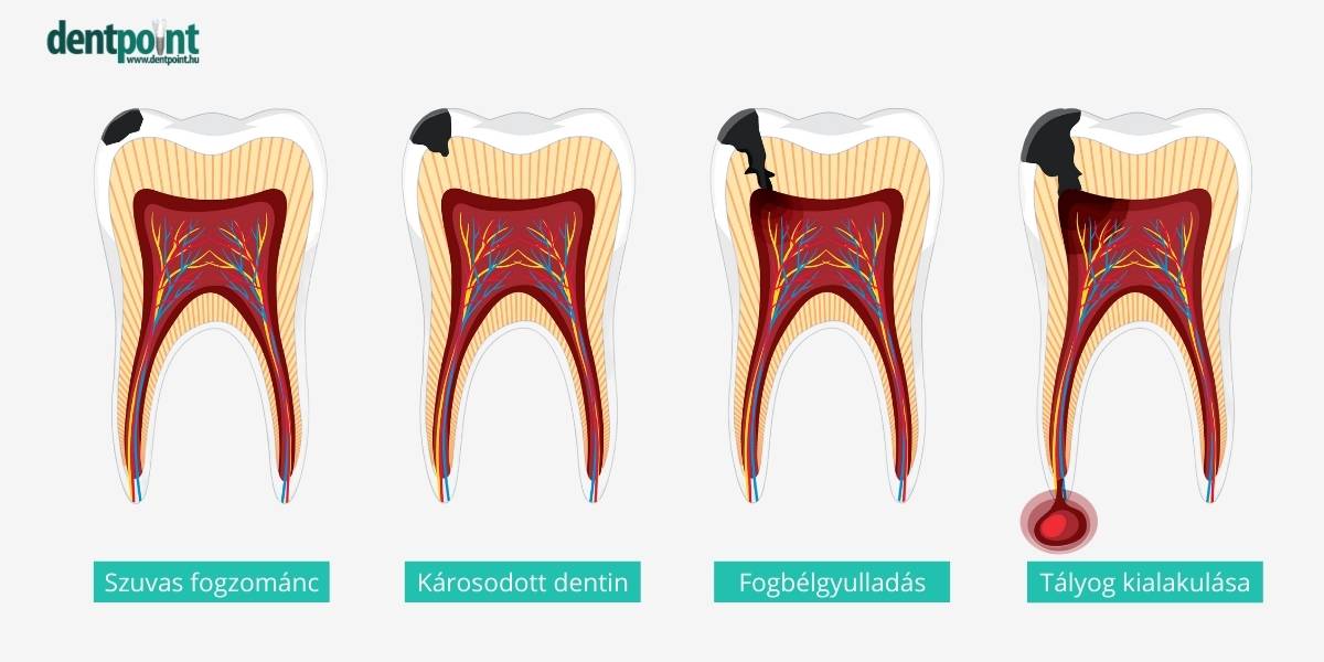 A kezeletlen fogszuvasodás is vezethet a fog elhalásához