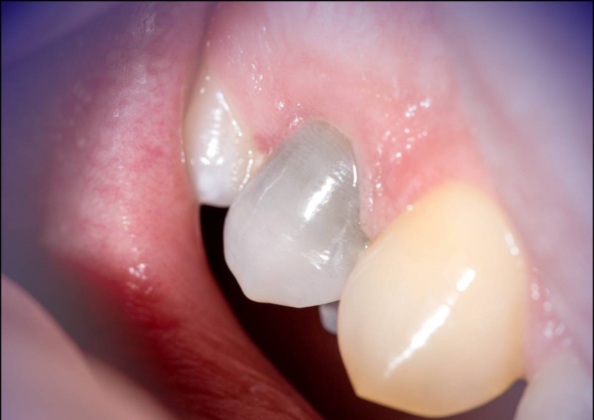 Az elhalt fog színe szürkéssé változhat