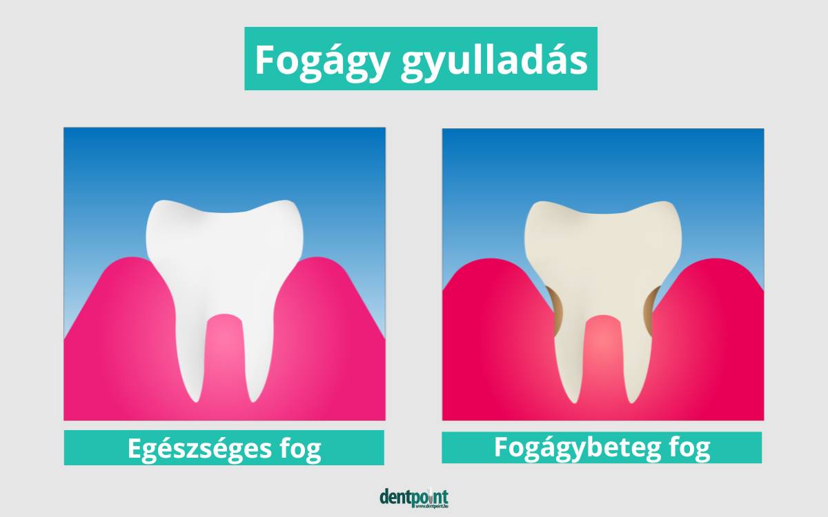 Milyen a fogágybeteg fog?