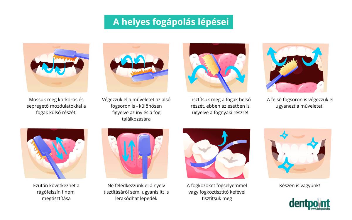 A fogínyvérzés ellen a helyes fogápolás a leghatékonyabb