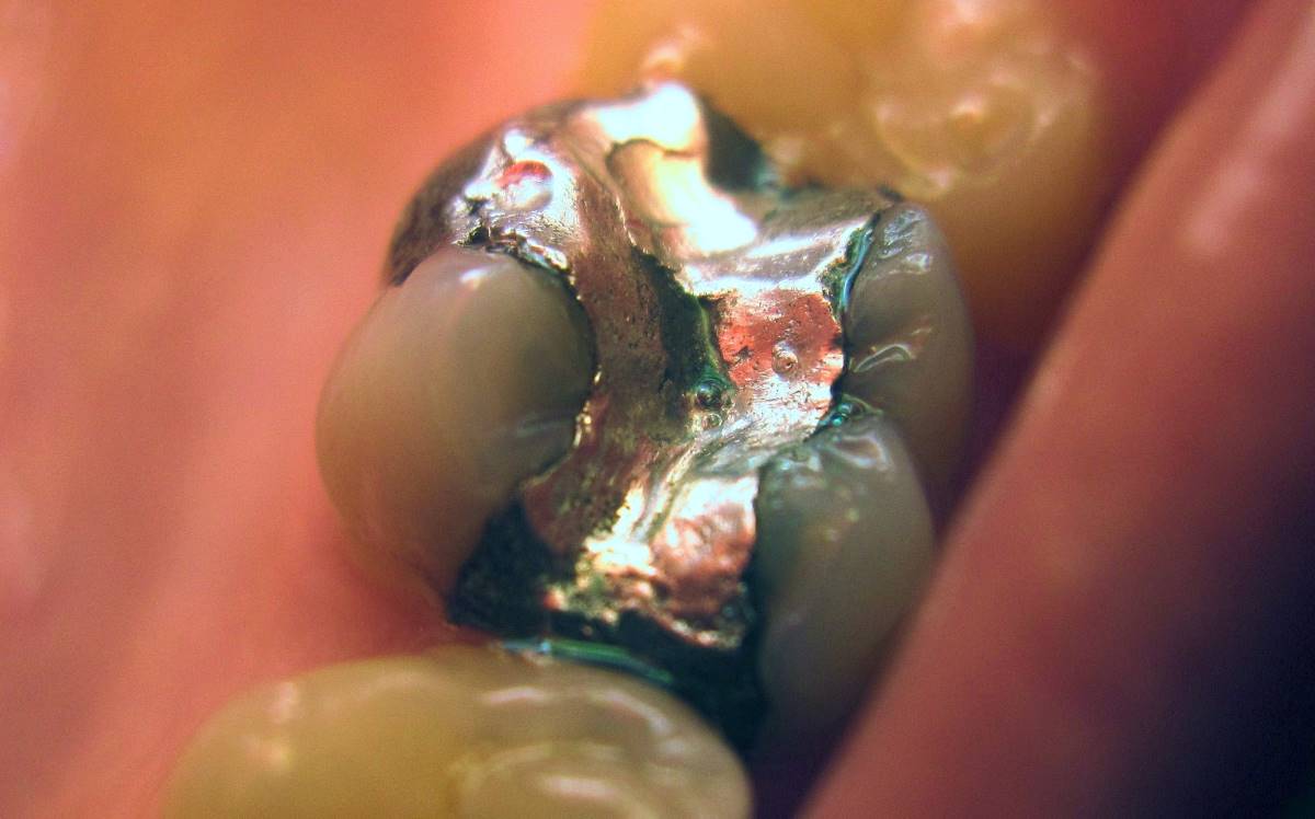 Az amalgám tömés megosztó a fogászatban