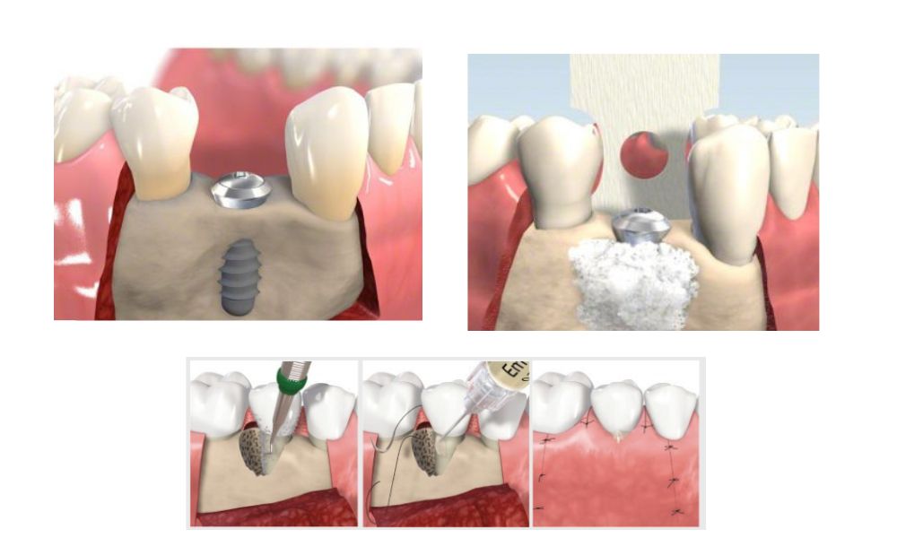 A sinus lift arcüreg emelés során csontpótló anyag bejuttatása történik