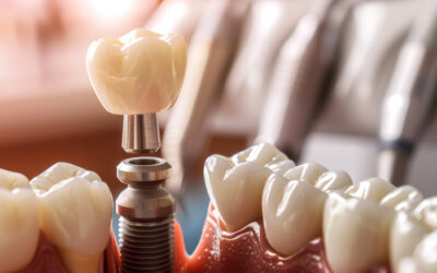 Rövid vs. hosszú implantátumok: mennyire számít a méret?