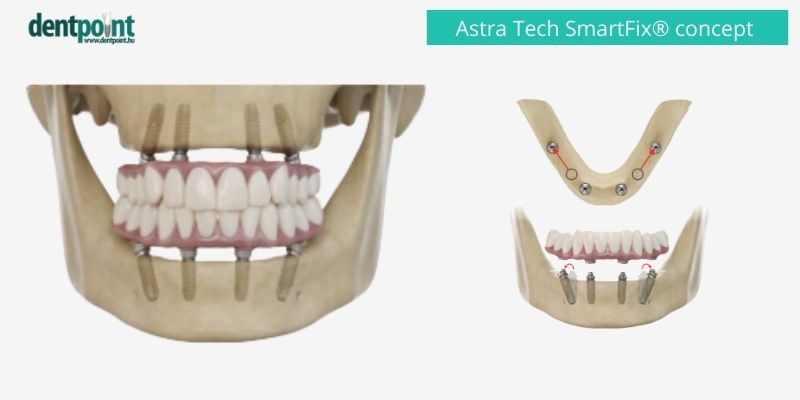 A 4 illetve 6 implantátumra csavarozott körhíd sok esetben csontpótlás nélkül is elkészíthető. 