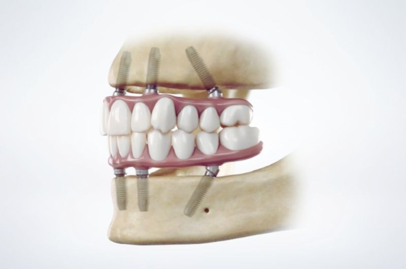4 és 6 implantátumra csavarozott körhíd: megoldás teljes foghiányra