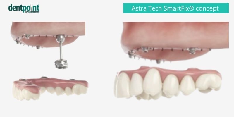 ha a csontállomány pusztulása nagyobb mértékű, 6 implantátumra is készíthető rögzített fog