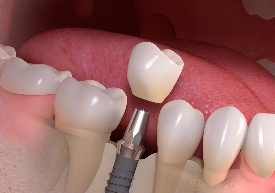 A periimplantitis kezelése lézerterápiával: Hatékony megoldás a fogászati implantátumok megmentésére