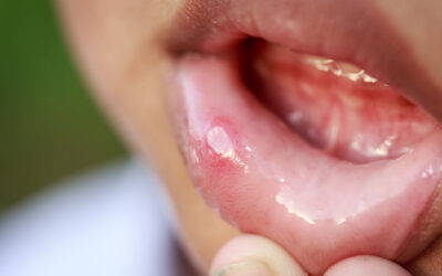 Afta a szájban: mikor ártalmatlan és mikor jelez komolyabb problémát?