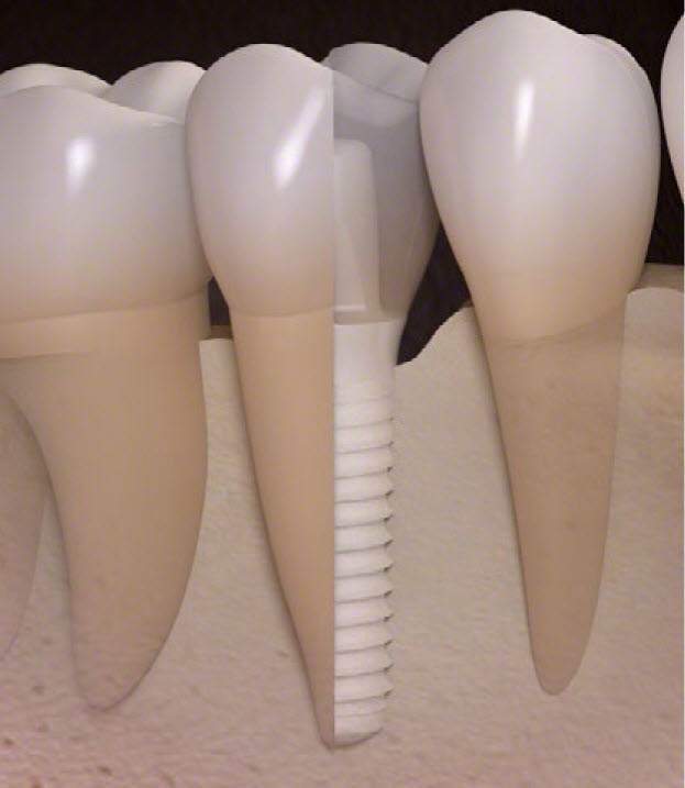 A vizsgálat egyik fő üzenete, hogy sem a vertikális, sem a horizontális távolság nem befolyásolta érdemben az implantátum hosszú távú megtartását vagy a csontvesztést.