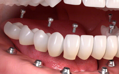 Számít a távolság? Mit érdemes tudni a fogászati implantátumok közti rések hatásáról