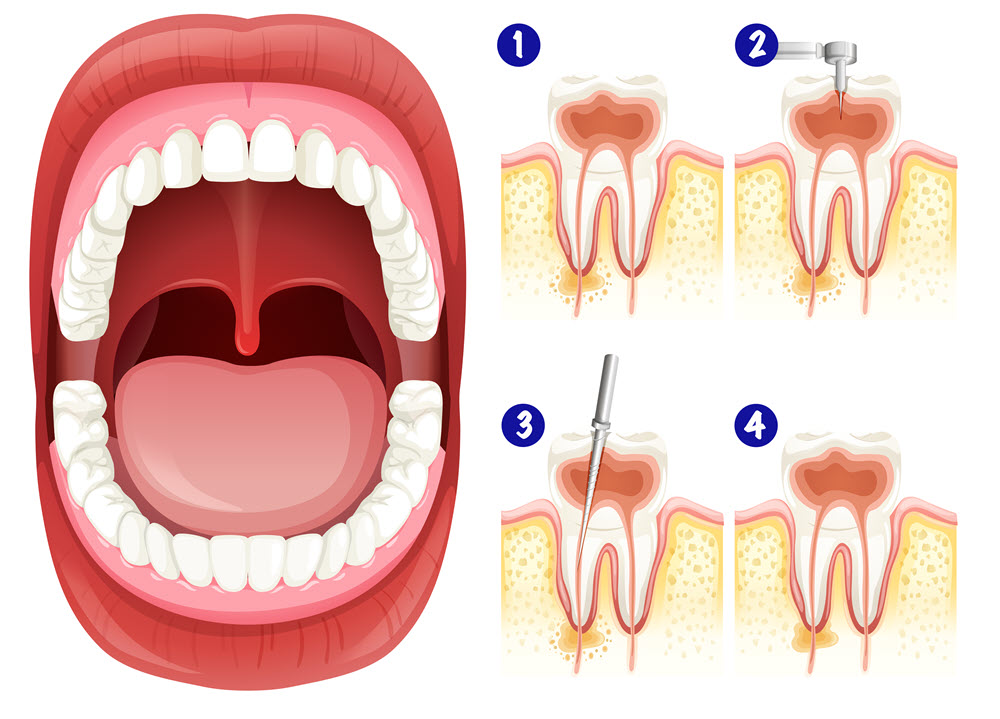 A gyökérkezelés célja a gyulladt, fertőzött vagy elhalt fogbél eltávolítása, valamint a gyökércsatornák precíz tisztítása és lezárása.